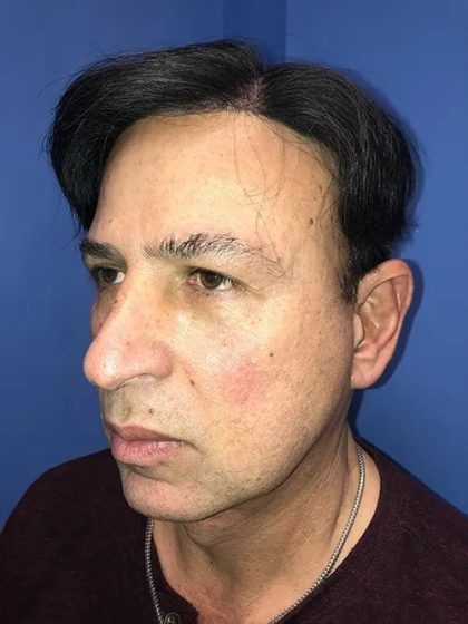 Facelift Before & After Patient #20995