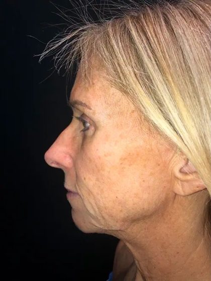 Facelift Before & After Patient #21161