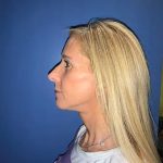Facelift Before & After Patient #21161