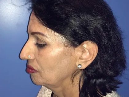 Facelift Before & After Patient #21162