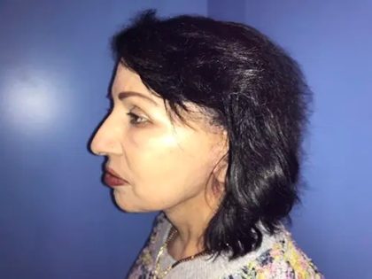 Facelift Before & After Patient #21162