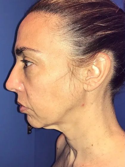 Facelift Before & After Patient #20997