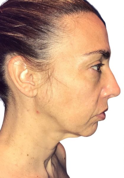 Facelift Before & After Patient #20997