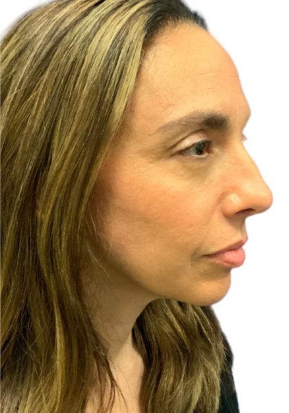 Facelift Before & After Patient #20997