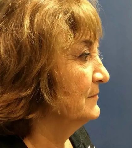 Facelift Before & After Patient #20998