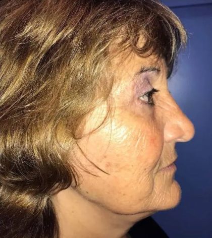 Facelift Before & After Patient #20998