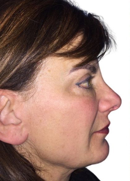 Facelift Before & After Patient #21000