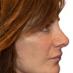 Facelift Before & After Patient #21000