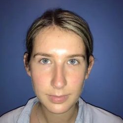 Otoplasty Before & After Patient #21170