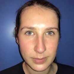 Otoplasty Before & After Patient #21170