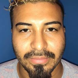 Otoplasty Before & After Patient #21164