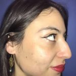 Rhinoplasty Before & After Patient #21215