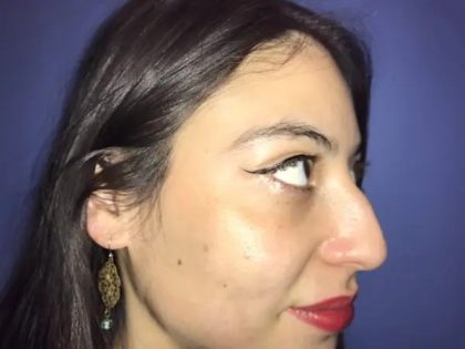 Rhinoplasty Before & After Patient #21215
