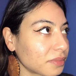 Rhinoplasty Before & After Patient #21215