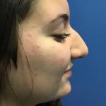 Rhinoplasty Before & After Patient #21203