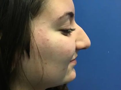 Rhinoplasty Before & After Patient #21203