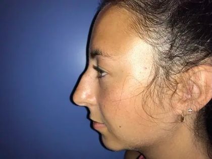 Rhinoplasty Before & After Patient #21219