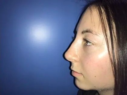 Rhinoplasty Before & After Patient #21219