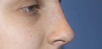 Rhinoplasty Before & After Patient #21173