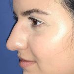 Rhinoplasty Before & After Patient #21177