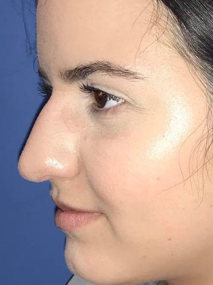Rhinoplasty Before & After Patient #21177