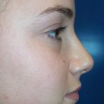 Rhinoplasty Before & After Patient #21191