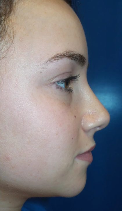 Rhinoplasty Before & After Patient #21191