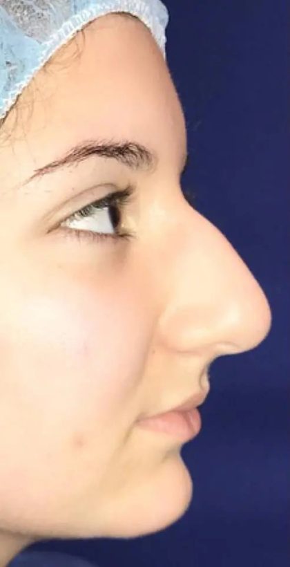 Rhinoplasty Before & After Patient #21192