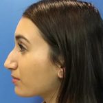 Rhinoplasty Before & After Patient #21193