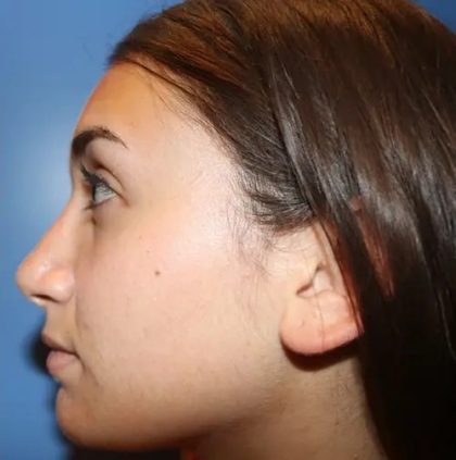 Rhinoplasty Before & After Patient #21193