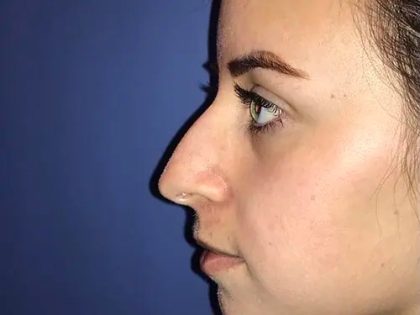 Rhinoplasty Before & After Patient #21198