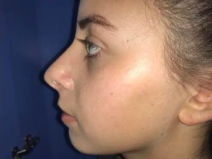 Rhinoplasty Before & After Patient #21198