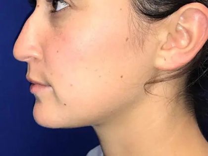 Rhinoplasty Before & After Patient #21200