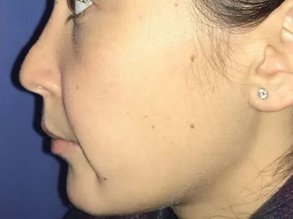 Rhinoplasty Before & After Patient #21200