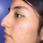 Rhinoplasty Before & After Patient #21201