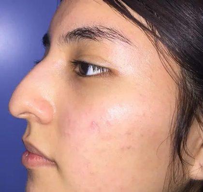 Rhinoplasty Before & After Patient #21201
