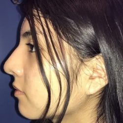 Rhinoplasty Before & After Patient #21201