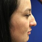 Rhinoplasty Before & After Patient #21209