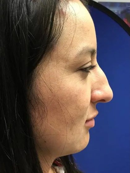 Rhinoplasty Before & After Patient #21209