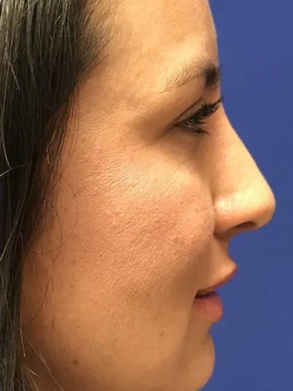 Rhinoplasty Before & After Patient #21209