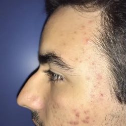 Rhinoplasty Before & After Patient #21202