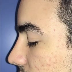 Rhinoplasty Before & After Patient #21202