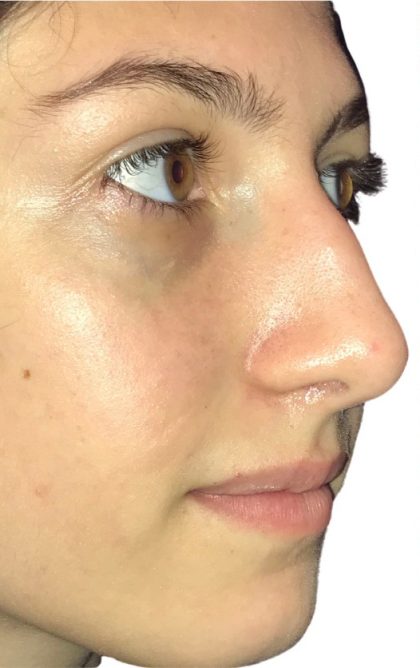 Rhinoplasty Before & After Patient #21219