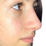 Rhinoplasty Before & After Patient #21219