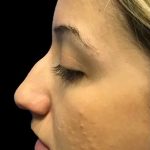 Rhinoplasty Before & After Patient #21220