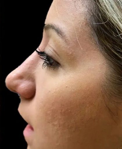 Rhinoplasty Before & After Patient #21220