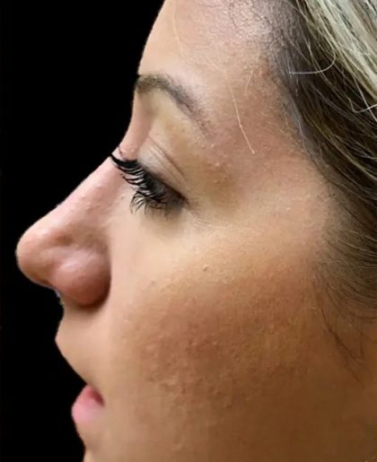 Rhinoplasty Before & After Patient #21220