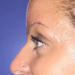 Rhinoplasty Before & After Patient #21221