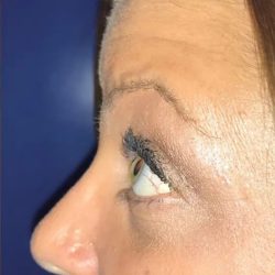 Rhinoplasty Before & After Patient #21221