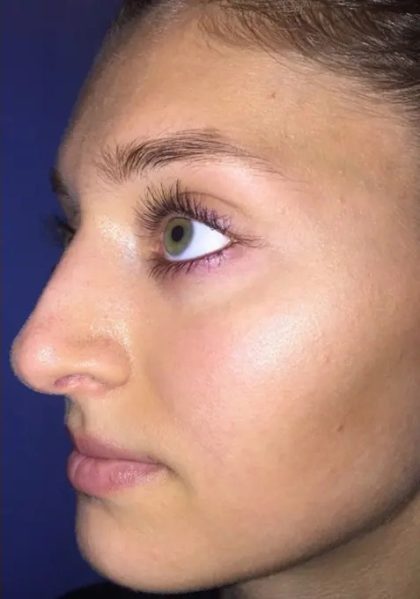 Rhinoplasty Before & After Patient #21222